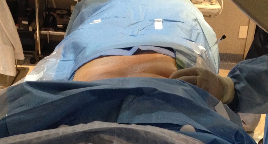 Discolisis en columna